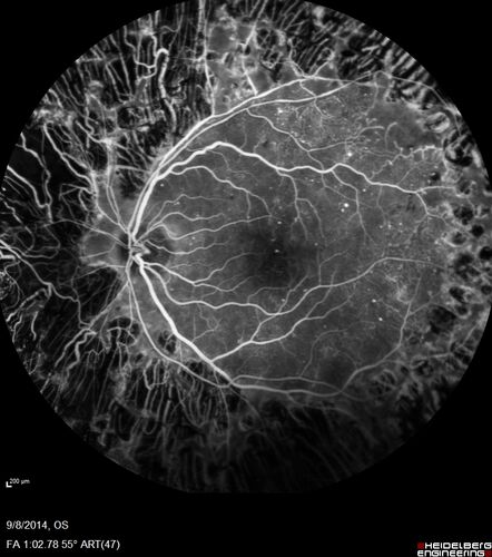 Proliferative Diabetic Retinopathy with Panretinal Photocoagulation
57 year old female Type 1 DM with prior laser about 10 years ago in Chicago.
HTN, Thyroid cancer and removal, Cardiovascular disease
Meds: ASA 325 mg /day, etc
Recent new floaters in the right eye:

VA 20/50 OD, 20/40 OS
