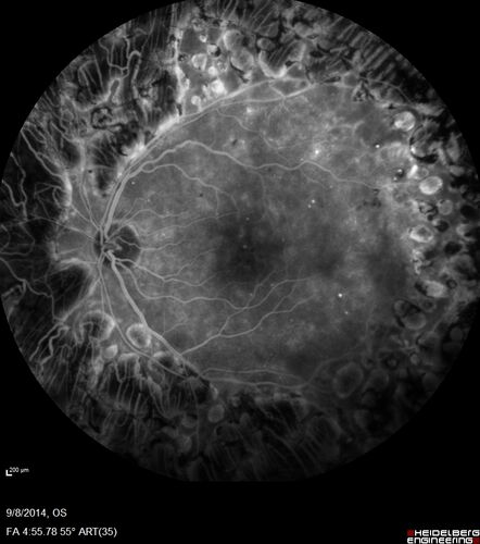 Proliferative Diabetic Retinopathy with Panretinal Photocoagulation
57 year old female Type 1 DM with prior laser about 10 years ago in Chicago.
HTN, Thyroid cancer and removal, Cardiovascular disease
Meds: ASA 325 mg /day, etc
Recent new floaters in the right eye:

VA 20/50 OD, 20/40 OS
