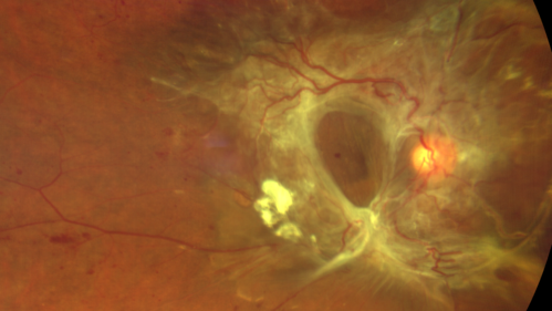 Severe diabetic tractional retinal detachment one year following diagnosis of type II Diabetes Mellitus
44 year old man The vision in the left eye started to decline about 4 days ago.Â  Prior to that the left eye was the better eye.Â  He was diagnosed with diabetes a year ago.Â  
VA OD: Dcc20/50-1 OS: Dcc20/125-2, TP: OD:12 OS:13

Following two surgeries in each eye, silicone oil remaining forever, monthly anti-VEGF for severe DME - BCVA OU 20/200 at 3 years
