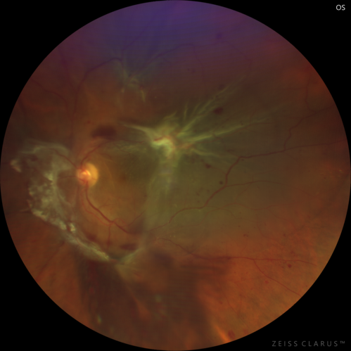 Severe diabetic tractional retinal detachment one year following diagnosis of type II Diabetes Mellitus
44 year old man The vision in the left eye started to decline about 4 days ago.Â  Prior to that the left eye was the better eye.Â  He was diagnosed with diabetes a year ago.Â  
VA OD: Dcc20/50-1 OS: Dcc20/125-2, TP: OD:12 OS:13

Following two surgeries in each eye, silicone oil remaining forever, monthly anti-VEGF for severe DME - BCVA OU 20/200 at 3 years
