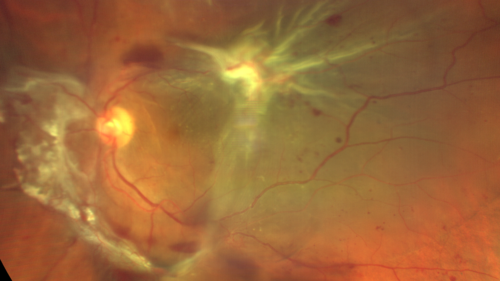 Severe diabetic tractional retinal detachment one year following diagnosis of type II Diabetes Mellitus
44 year old man The vision in the left eye started to decline about 4 days ago.Â  Prior to that the left eye was the better eye.Â  He was diagnosed with diabetes a year ago.Â  
VA OD: Dcc20/50-1 OS: Dcc20/125-2, TP: OD:12 OS:13

Following two surgeries in each eye, silicone oil remaining forever, monthly anti-VEGF for severe DME - BCVA OU 20/200 at 3 years
