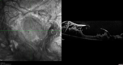 Severe diabetic tractional retinal detachment one year following diagnosis of type II Diabetes Mellitus
44 year old man The vision in the left eye started to decline about 4 days ago.Â  Prior to that the left eye was the better eye.Â  He was diagnosed with diabetes a year ago.Â  
VA OD: Dcc20/50-1 OS: Dcc20/125-2, TP: OD:12 OS:13

Following two surgeries in each eye, silicone oil remaining forever, monthly anti-VEGF for severe DME - BCVA OU 20/200 at 3 years
