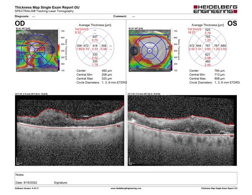 Severe diabetic tractional retinal detachment one year following diagnosis of type II Diabetes Mellitus
44 year old man The vision in the left eye started to decline about 4 days ago.Â  Prior to that the left eye was the better eye.Â  He was diagnosed with diabetes a year ago.Â  
VA OD: Dcc20/50-1 OS: Dcc20/125-2, TP: OD:12 OS:13

Following two surgeries in each eye, silicone oil remaining forever, monthly anti-VEGF for severe DME - BCVA OU 20/200 at 3 years
