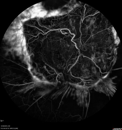 Severe diabetic tractional retinal detachment one year following diagnosis of type II Diabetes Mellitus
44 year old man The vision in the left eye started to decline about 4 days ago.Â  Prior to that the left eye was the better eye.Â  He was diagnosed with diabetes a year ago.Â  
VA OD: Dcc20/50-1 OS: Dcc20/125-2, TP: OD:12 OS:13

Following two surgeries in each eye, silicone oil remaining forever, monthly anti-VEGF for severe DME - BCVA OU 20/200 at 3 years
