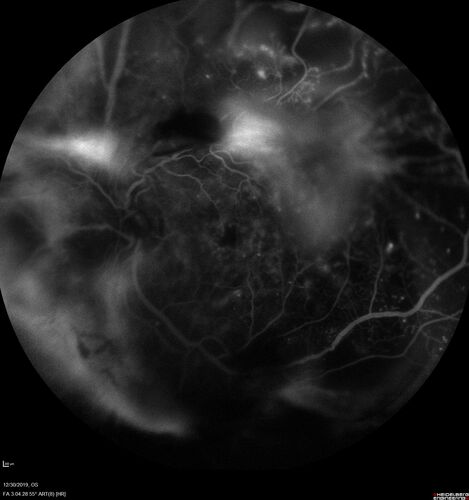 Severe diabetic tractional retinal detachment one year following diagnosis of type II Diabetes Mellitus
44 year old man The vision in the left eye started to decline about 4 days ago.Â  Prior to that the left eye was the better eye.Â  He was diagnosed with diabetes a year ago.Â  
VA OD: Dcc20/50-1 OS: Dcc20/125-2, TP: OD:12 OS:13

Following two surgeries in each eye, silicone oil remaining forever, monthly anti-VEGF for severe DME - BCVA OU 20/200 at 3 years

