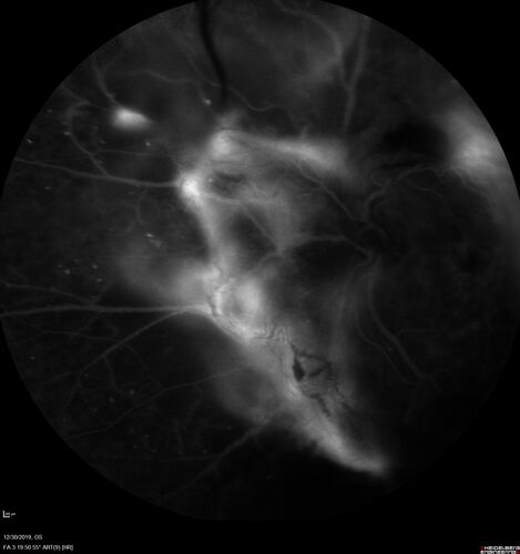 Severe diabetic tractional retinal detachment one year following diagnosis of type II Diabetes Mellitus
44 year old man The vision in the left eye started to decline about 4 days ago.Â  Prior to that the left eye was the better eye.Â  He was diagnosed with diabetes a year ago.Â  
VA OD: Dcc20/50-1 OS: Dcc20/125-2, TP: OD:12 OS:13

Following two surgeries in each eye, silicone oil remaining forever, monthly anti-VEGF for severe DME - BCVA OU 20/200 at 3 years
