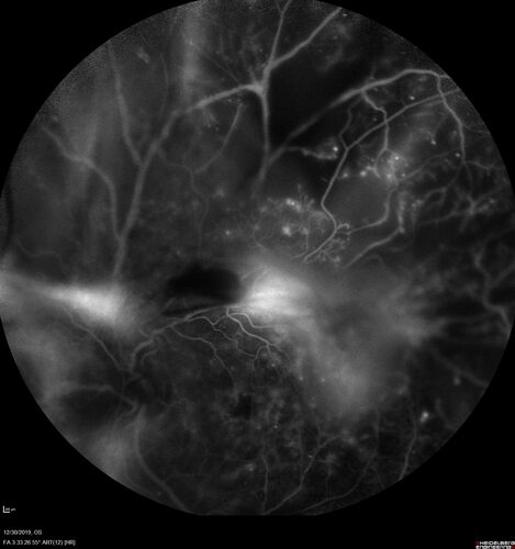 Severe diabetic tractional retinal detachment one year following diagnosis of type II Diabetes Mellitus
44 year old man The vision in the left eye started to decline about 4 days ago.Â  Prior to that the left eye was the better eye.Â  He was diagnosed with diabetes a year ago.Â  
VA OD: Dcc20/50-1 OS: Dcc20/125-2, TP: OD:12 OS:13

Following two surgeries in each eye, silicone oil remaining forever, monthly anti-VEGF for severe DME - BCVA OU 20/200 at 3 years
