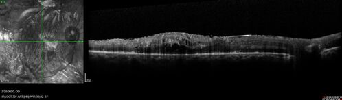 Severe diabetic tractional retinal detachment one year following diagnosis of type II Diabetes Mellitus
44 year old man The vision in the left eye started to decline about 4 days ago.Â  Prior to that the left eye was the better eye.Â  He was diagnosed with diabetes a year ago.Â  
VA OD: Dcc20/50-1 OS: Dcc20/125-2, TP: OD:12 OS:13

Following two surgeries in each eye, silicone oil remaining forever, monthly anti-VEGF for severe DME - BCVA OU 20/200 at 3 years
