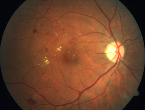 Proliferative Diabetic Retinopathy and vitreous hemorrhage left eye
44 year old man with type II diabetes for 14 years and no eye examinations in the last 5 years.  VA 20/40 right eye and 20/60 left eye.  Vision loss has been for about a week in the left eye.
