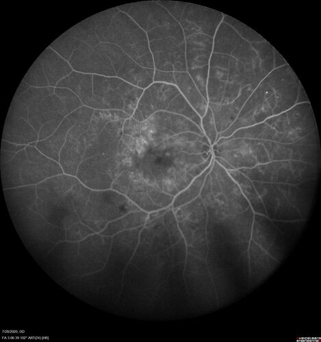 Proliferative Diabetic Retinopathy and vitreous hemorrhage left eye
44 year old man with type II diabetes for 14 years and no eye examinations in the last 5 years.  VA 20/40 right eye and 20/60 left eye.  Vision loss has been for about a week in the left eye.

