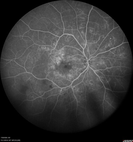 Proliferative Diabetic Retinopathy and vitreous hemorrhage left eye
44 year old man with type II diabetes for 14 years and no eye examinations in the last 5 years.  VA 20/40 right eye and 20/60 left eye.  Vision loss has been for about a week in the left eye.
