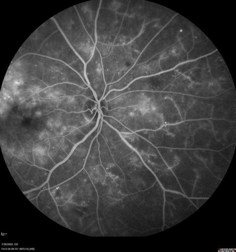 Proliferative Diabetic Retinopathy and vitreous hemorrhage left eye
44 year old man with type II diabetes for 14 years and no eye examinations in the last 5 years.  VA 20/40 right eye and 20/60 left eye.  Vision loss has been for about a week in the left eye.

