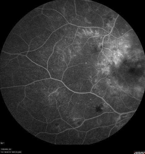 Proliferative Diabetic Retinopathy and vitreous hemorrhage left eye
44 year old man with type II diabetes for 14 years and no eye examinations in the last 5 years.  VA 20/40 right eye and 20/60 left eye.  Vision loss has been for about a week in the left eye.
