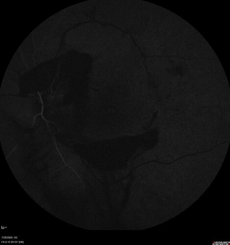 Proliferative Diabetic Retinopathy and vitreous hemorrhage left eye
44 year old man with type II diabetes for 14 years and no eye examinations in the last 5 years.  VA 20/40 right eye and 20/60 left eye.  Vision loss has been for about a week in the left eye.
