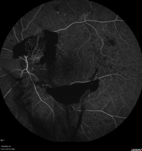 Proliferative Diabetic Retinopathy and vitreous hemorrhage left eye
44 year old man with type II diabetes for 14 years and no eye examinations in the last 5 years.  VA 20/40 right eye and 20/60 left eye.  Vision loss has been for about a week in the left eye.
