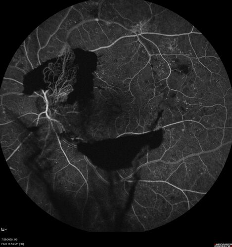 Proliferative Diabetic Retinopathy and vitreous hemorrhage left eye
44 year old man with type II diabetes for 14 years and no eye examinations in the last 5 years.  VA 20/40 right eye and 20/60 left eye.  Vision loss has been for about a week in the left eye.
