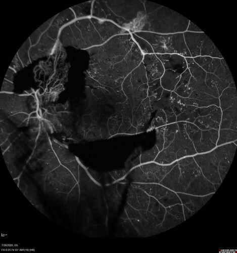 Proliferative Diabetic Retinopathy and vitreous hemorrhage left eye
44 year old man with type II diabetes for 14 years and no eye examinations in the last 5 years.  VA 20/40 right eye and 20/60 left eye.  Vision loss has been for about a week in the left eye.
