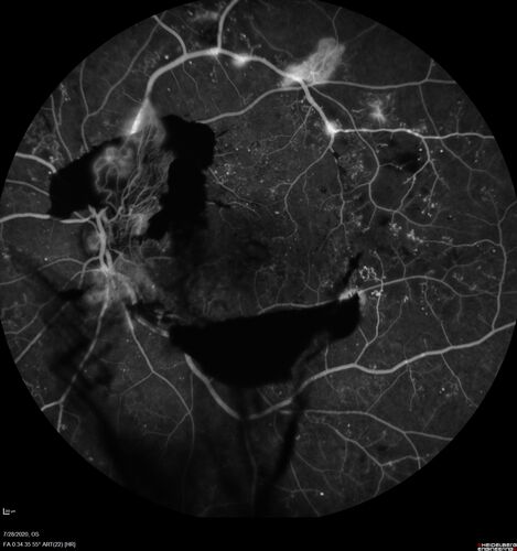 Proliferative Diabetic Retinopathy and vitreous hemorrhage left eye
44 year old man with type II diabetes for 14 years and no eye examinations in the last 5 years.  VA 20/40 right eye and 20/60 left eye.  Vision loss has been for about a week in the left eye.
