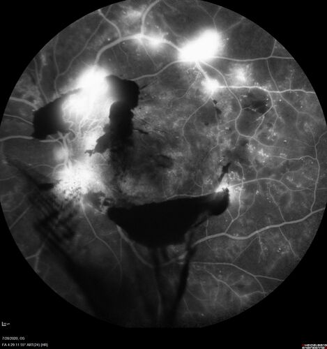 Proliferative Diabetic Retinopathy and vitreous hemorrhage left eye
44 year old man with type II diabetes for 14 years and no eye examinations in the last 5 years.  VA 20/40 right eye and 20/60 left eye.  Vision loss has been for about a week in the left eye.
