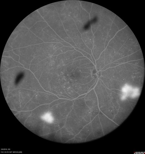 Mild Proliferative Diabetic Retinopathy
Right eye has NVE and left eye has NVD and NVE.  VA 20/25 OU.

