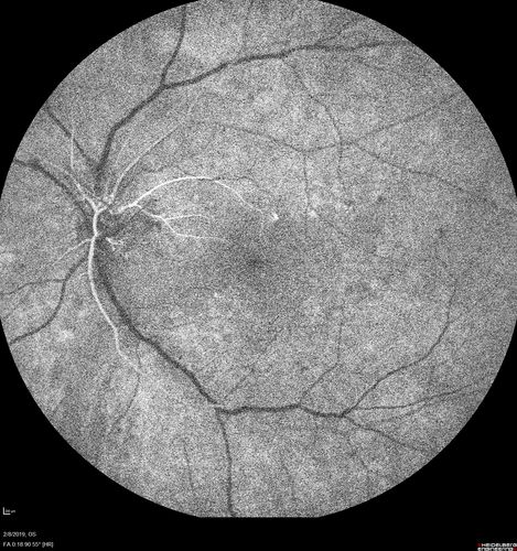 Mild Proliferative Diabetic Retinopathy
Right eye has NVE and left eye has NVD and NVE.  VA 20/25 OU.
