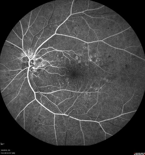Mild Proliferative Diabetic Retinopathy
Right eye has NVE and left eye has NVD and NVE.  VA 20/25 OU.
