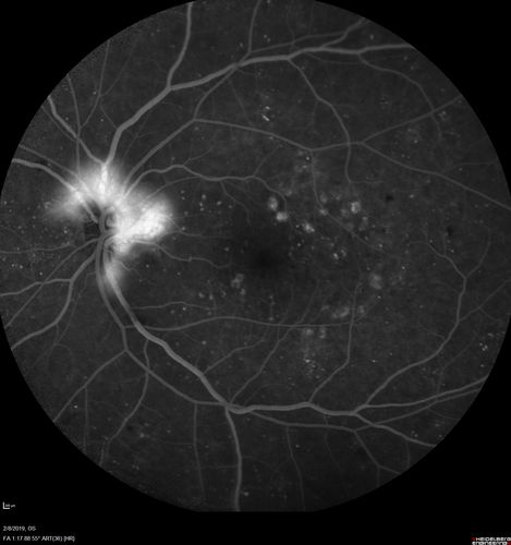 Mild Proliferative Diabetic Retinopathy
Right eye has NVE and left eye has NVD and NVE.  VA 20/25 OU.

