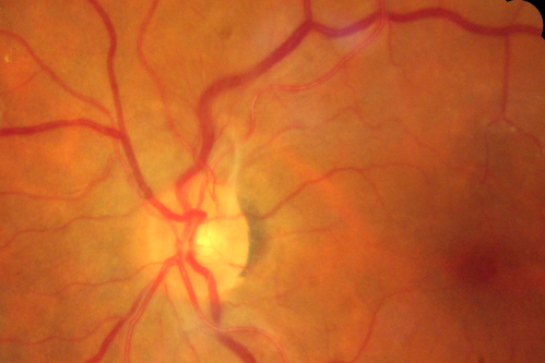 Lacy Neovascularization of the Disk - Color Photo
