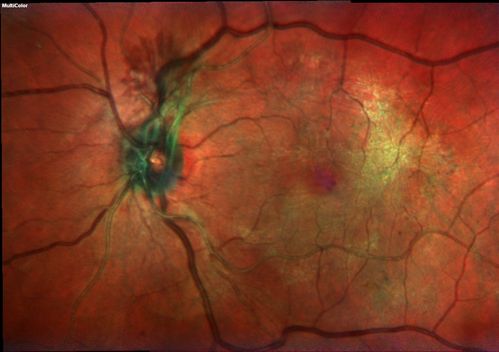 NVD - proliferative diabetic retinopathy Heidelberg False Color
