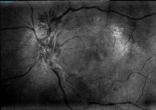 NVD - proliferative diabetic retinopathy Heidelberg False Color
