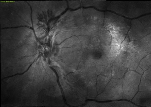 NVD - proliferative diabetic retinopathy Heidelberg False Color
