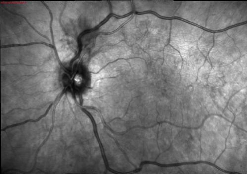 NVD - proliferative diabetic retinopathy
