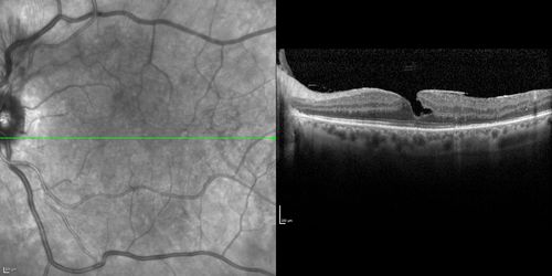 No significant macular edema
