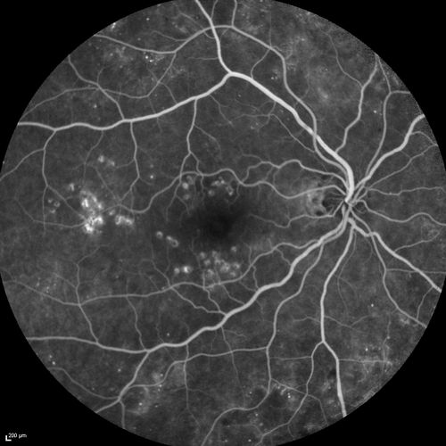 BDR right eye - previous laser
