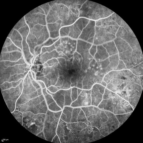 FA showing NVE, NVD, non- perfusion left eye inferonasally with neovascularization at the margin of the non-perfusion
