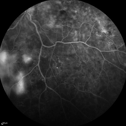 FA showing NVE, NVD, non- perfusion left eye inferonasally with neovascularization at the margin of the non-perfusion
