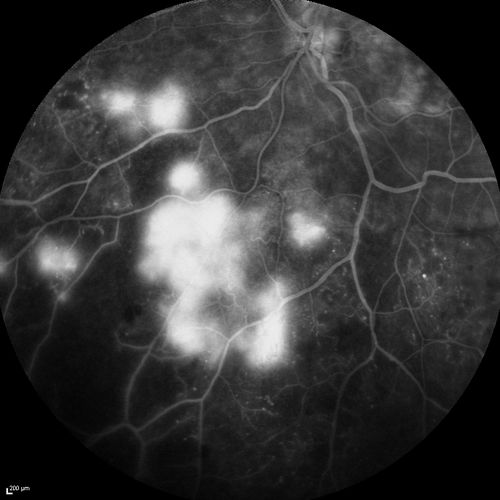FA showing NVE, NVD, non- perfusion left eye inferonasally with neovascularization at the margin of the non-perfusion (heavy leakage from NV)
