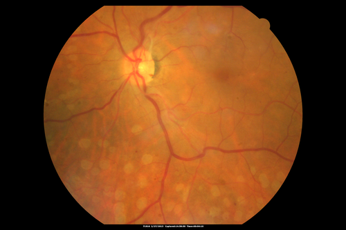Panretinal (Scatter) Photocoagulation (Fresh)
