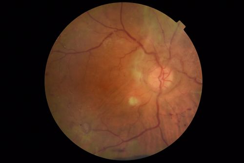 Severe PDR with preretinal fibrosis
71 year old female untreated for a year following injections because of hurricane Irma.  VA 20/30 OD and 5/200 OS.  Sudden vision loss 1 month ago left eye was likely an ischemic event.  Right eye is being treated with injections and PRP laser.
