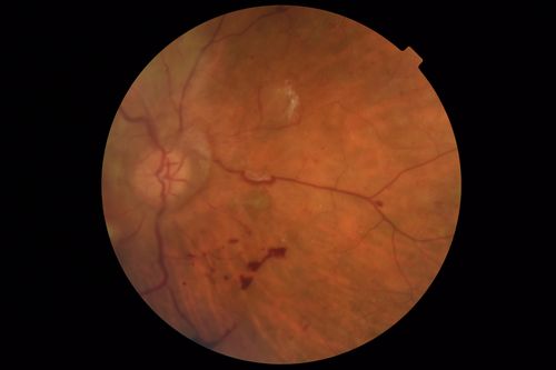 Severe PDR with preretinal fibrosis
71 year old female untreated for a year following injections because of hurricane Irma.  VA 20/30 OD and 5/200 OS.  Sudden vision loss 1 month ago left eye was likely an ischemic event.  Right eye is being treated with injections and PRP laser.

