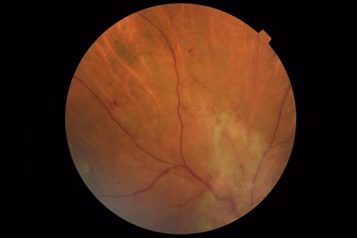 Severe PDR with preretinal fibrosis
71 year old female untreated for a year following injections because of hurricane Irma.  VA 20/30 OD and 5/200 OS.  Sudden vision loss 1 month ago left eye was likely an ischemic event.  Right eye is being treated with injections and PRP laser.

