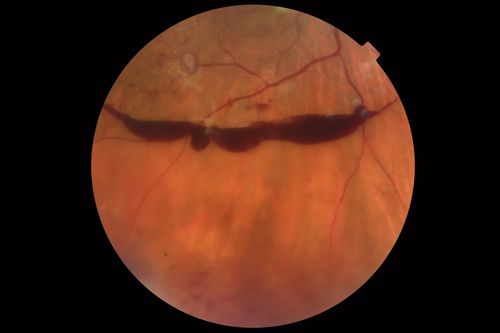 Severe PDR with preretinal fibrosis
71 year old female untreated for a year following injections because of hurricane Irma.  VA 20/30 OD and 5/200 OS.  Sudden vision loss 1 month ago left eye was likely an ischemic event.  Right eye is being treated with injections and PRP laser.
