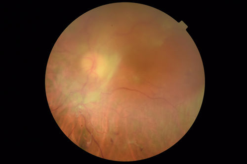 Severe PDR with preretinal fibrosis
71 year old female untreated for a year following injections because of hurricane Irma.  VA 20/30 OD and 5/200 OS.  Sudden vision loss 1 month ago left eye was likely an ischemic event.  Right eye is being treated with injections and PRP laser.
