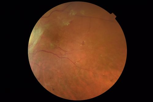 Severe PDR with preretinal fibrosis
71 year old female untreated for a year following injections because of hurricane Irma.  VA 20/30 OD and 5/200 OS.  Sudden vision loss 1 month ago left eye was likely an ischemic event.  Right eye is being treated with injections and PRP laser.
