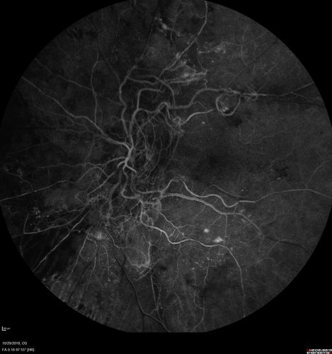 Severe PDR with preretinal fibrosis
71 year old female untreated for a year following injections because of hurricane Irma.  VA 20/30 OD and 5/200 OS.  Sudden vision loss 1 month ago left eye was likely an ischemic event.  Right eye is being treated with injections and PRP laser.

