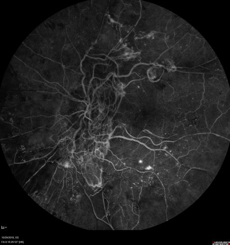 Severe PDR with preretinal fibrosis
71 year old female untreated for a year following injections because of hurricane Irma.  VA 20/30 OD and 5/200 OS.  Sudden vision loss 1 month ago left eye was likely an ischemic event.  Right eye is being treated with injections and PRP laser.
