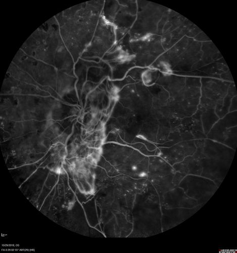 Severe PDR with preretinal fibrosis
71 year old female untreated for a year following injections because of hurricane Irma.  VA 20/30 OD and 5/200 OS.  Sudden vision loss 1 month ago left eye was likely an ischemic event.  Right eye is being treated with injections and PRP laser.
