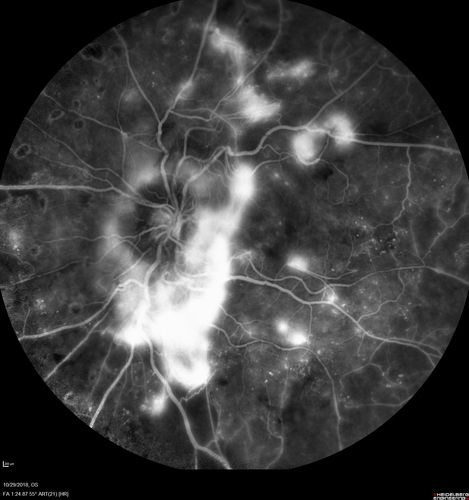 Severe PDR with preretinal fibrosis
71 year old female untreated for a year following injections because of hurricane Irma.  VA 20/30 OD and 5/200 OS.  Sudden vision loss 1 month ago left eye was likely an ischemic event.  Right eye is being treated with injections and PRP laser.
