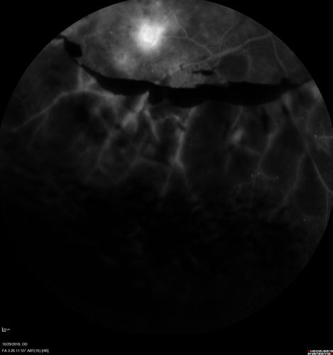 Severe PDR with preretinal fibrosis
71 year old female untreated for a year following injections because of hurricane Irma.  VA 20/30 OD and 5/200 OS.  Sudden vision loss 1 month ago left eye was likely an ischemic event.  Right eye is being treated with injections and PRP laser.
