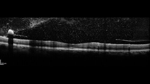 Severe Proliferative Diabetic Retinopathy and Good Vision
49 year old man with vision loss in the right eye for 2 weeks.  VA 20/40 OD, 20/63 OS.  DM x 15 years and HTN.
